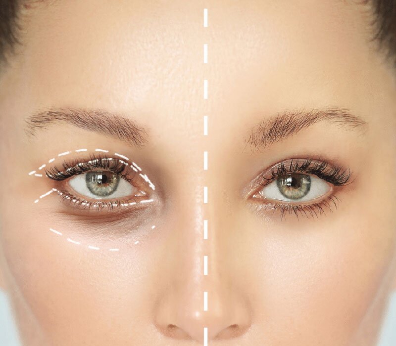 Blepharoplasty Surgery Cost in Delhi