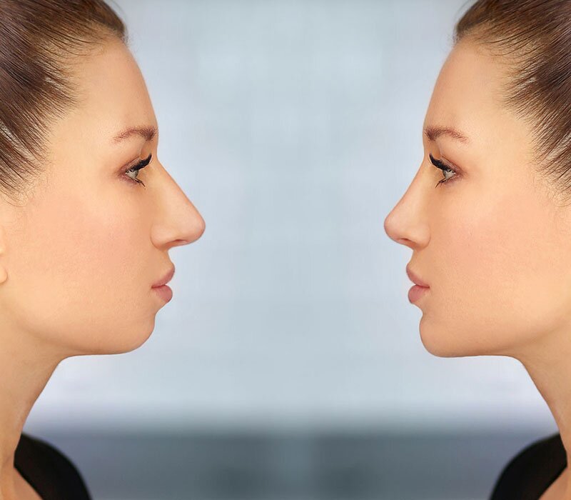 Chin Implant Surgery Cost in Delhi