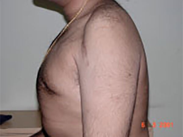 gynecomastia-after-img-CAPS-2022