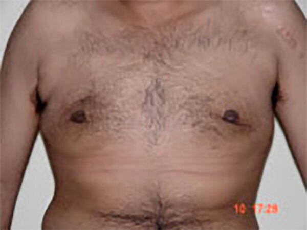 gynecomastia-after1-img-CAPS-2022