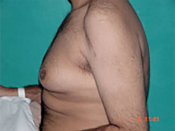 gynecomastia-before-img-CAPS-2022