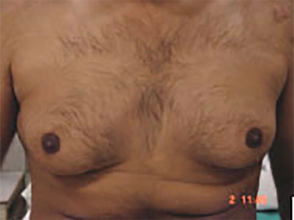 gynecomastia-before1-img-CAPS-2022