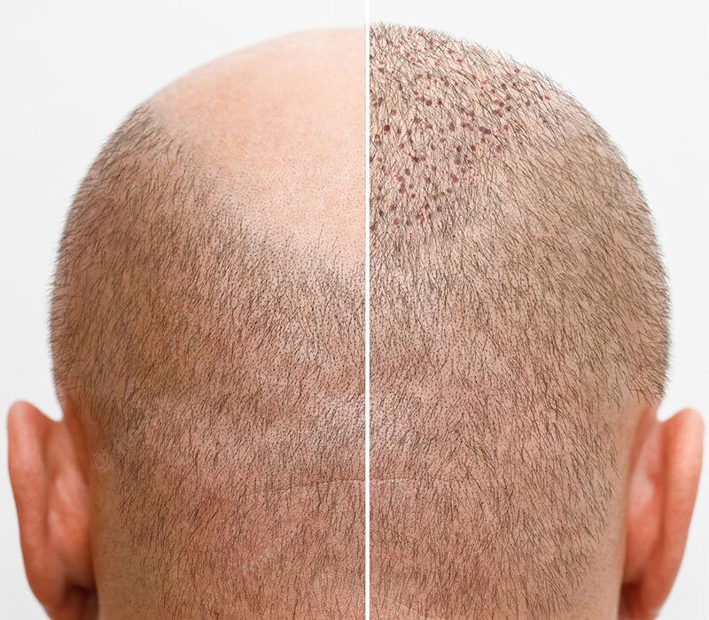 Best Hair Transplant in South Delhi